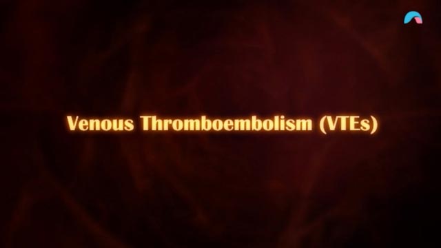 Cover image for: Venous Thromboembolism