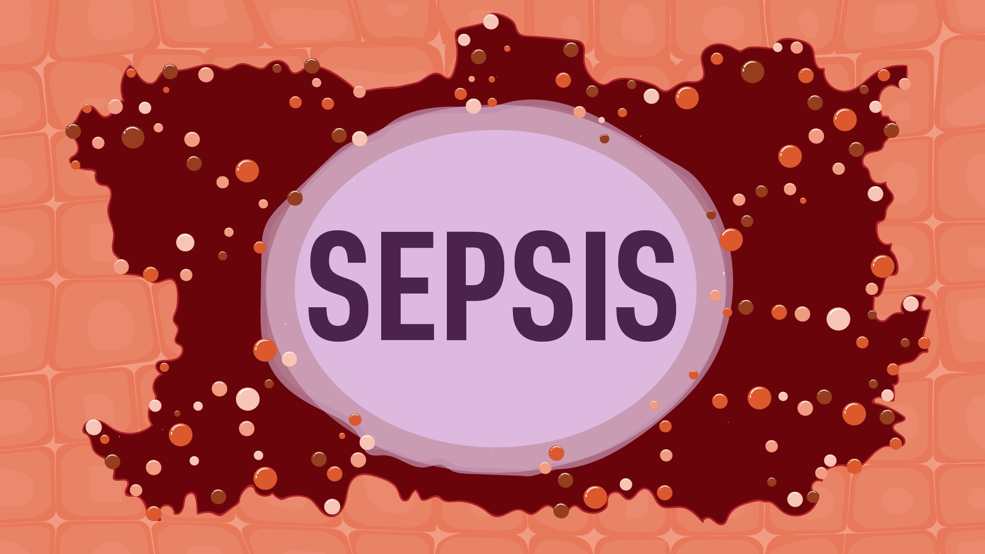 Image for Sepsis