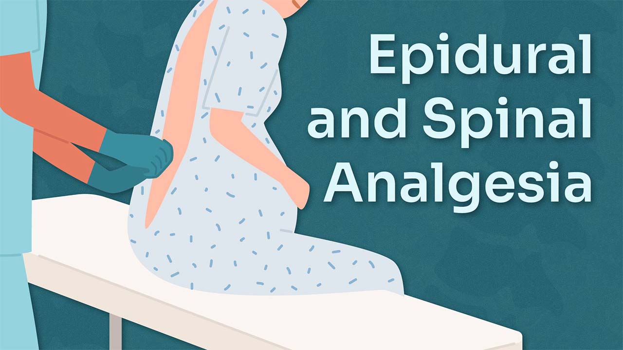 Image for Epidural and Spinal Analgesia