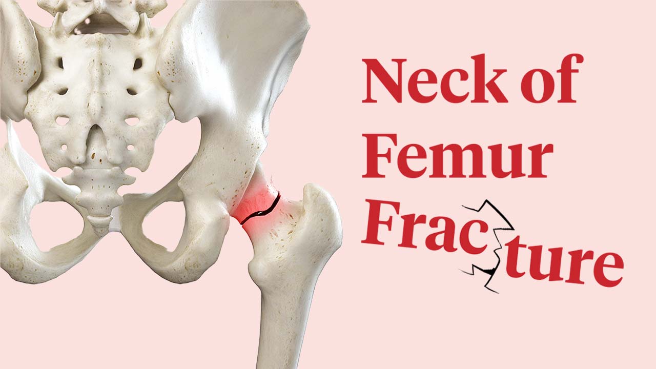 Cover image for: Neck of Femur Fracture