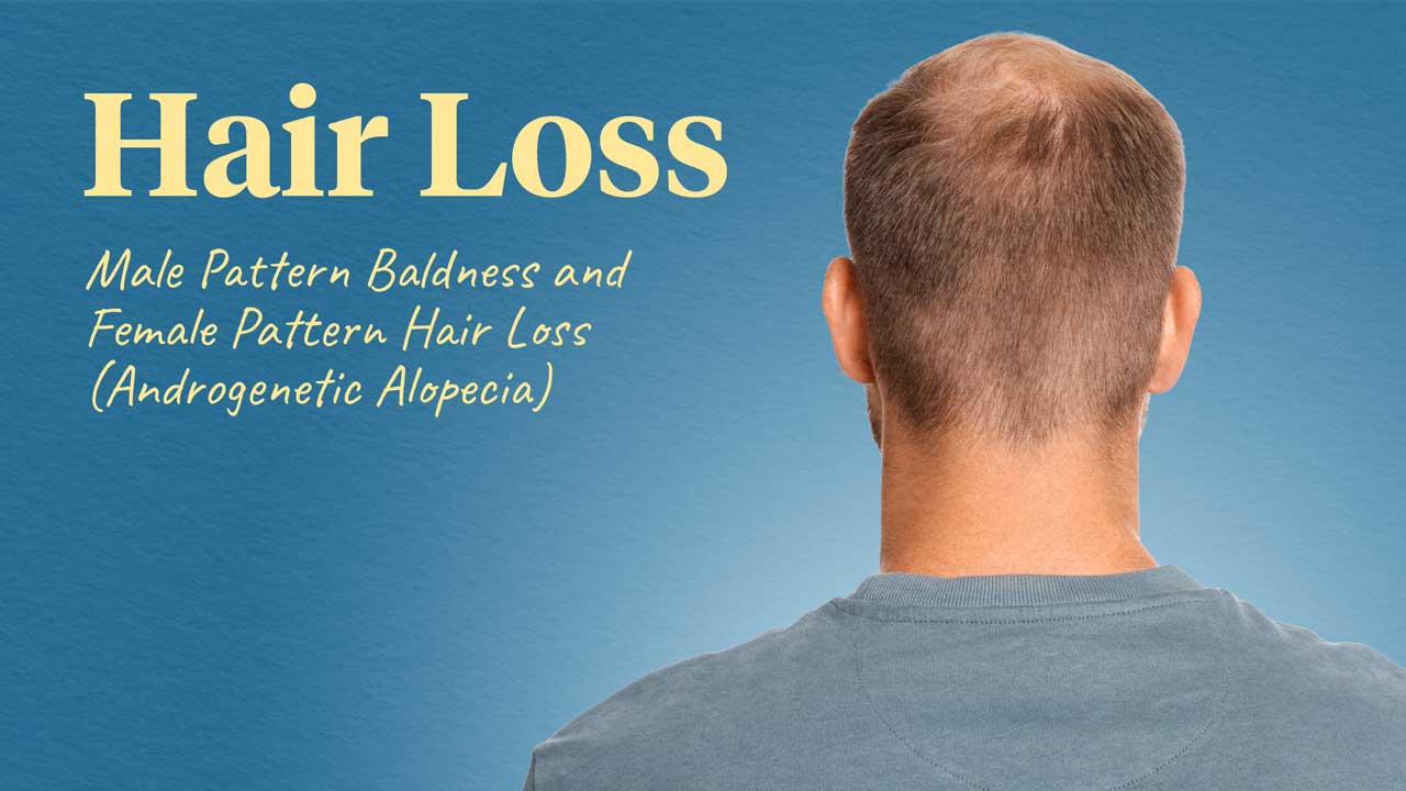 Cover image for: Hair Loss
